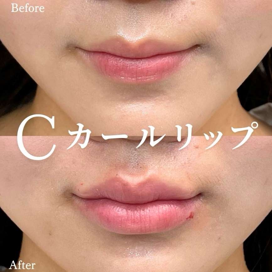 Cカールリップの症例写真