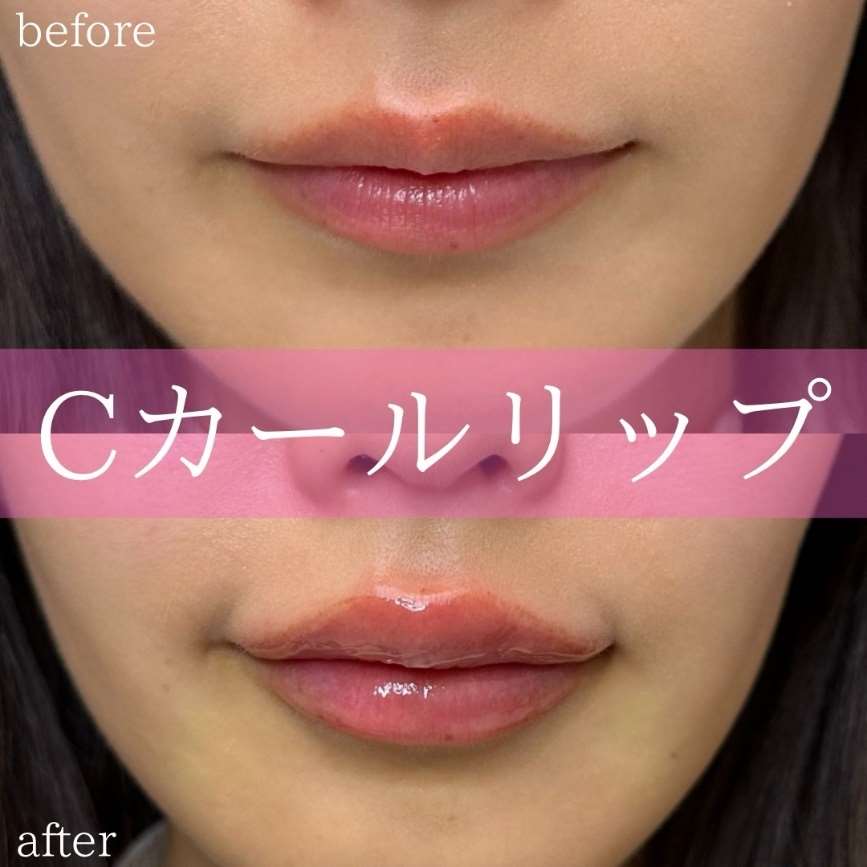 Cカールリップの症例写真