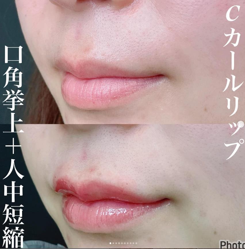 Cカールリップの症例写真