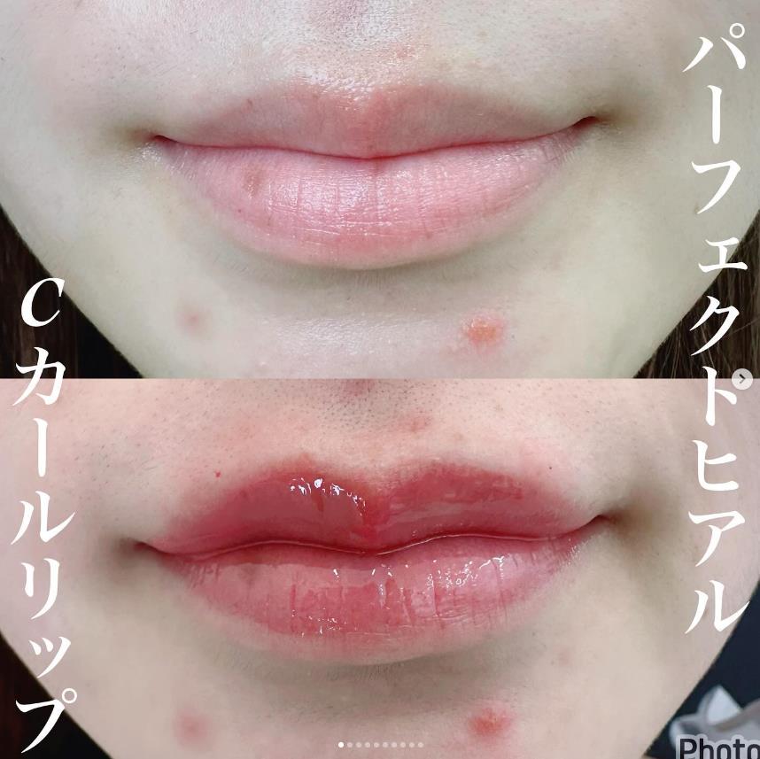 Cカールリップの症例写真