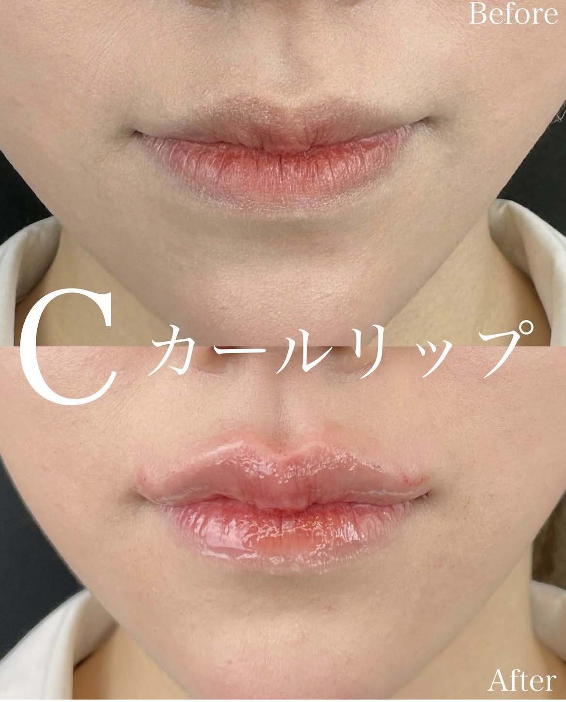 Cカールリップの症例写真