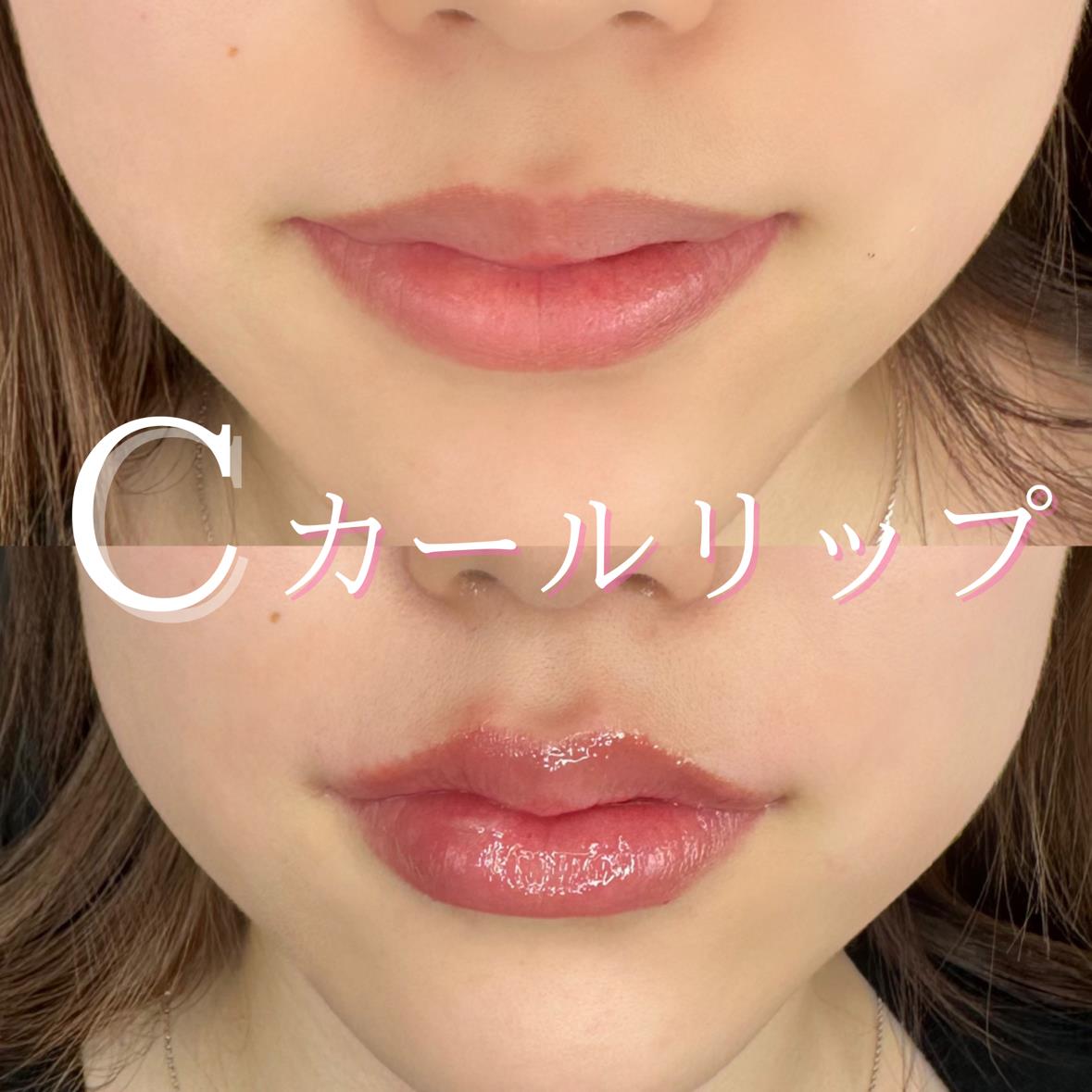 Cカールリップの症例写真