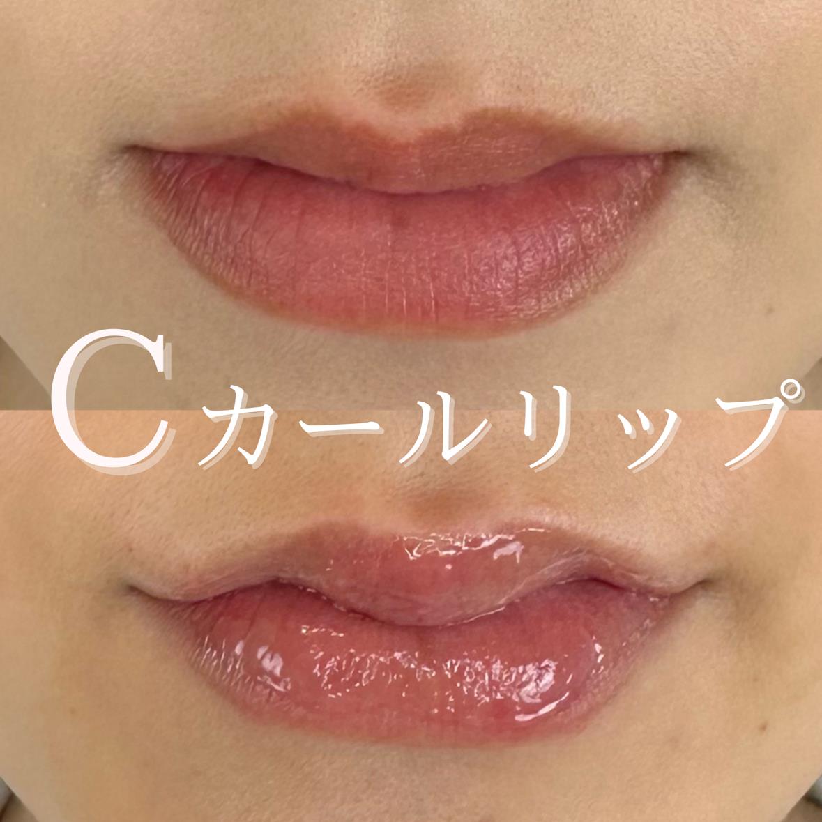 Cカールリップの症例写真