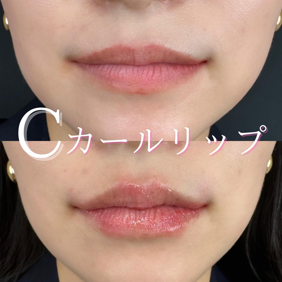 Cカールリップの症例写真