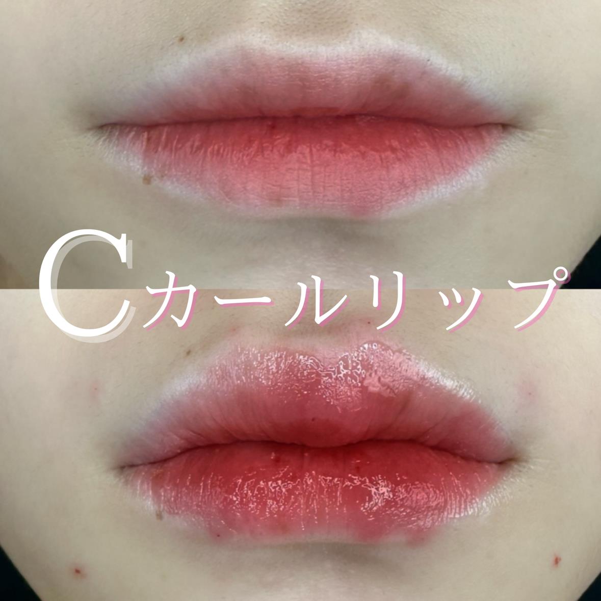 Cカールリップの症例写真