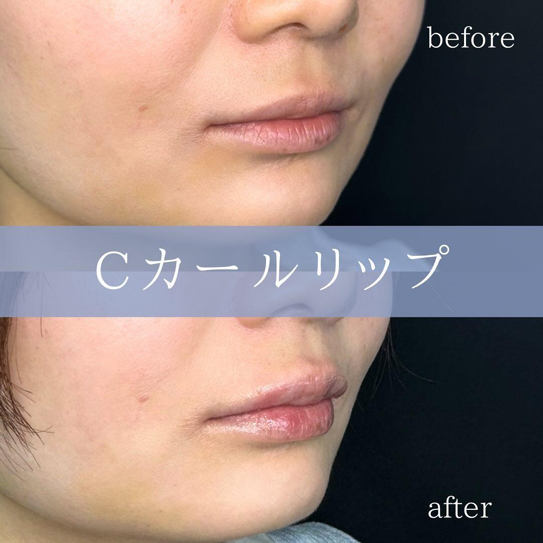 Cカールリップの症例写真