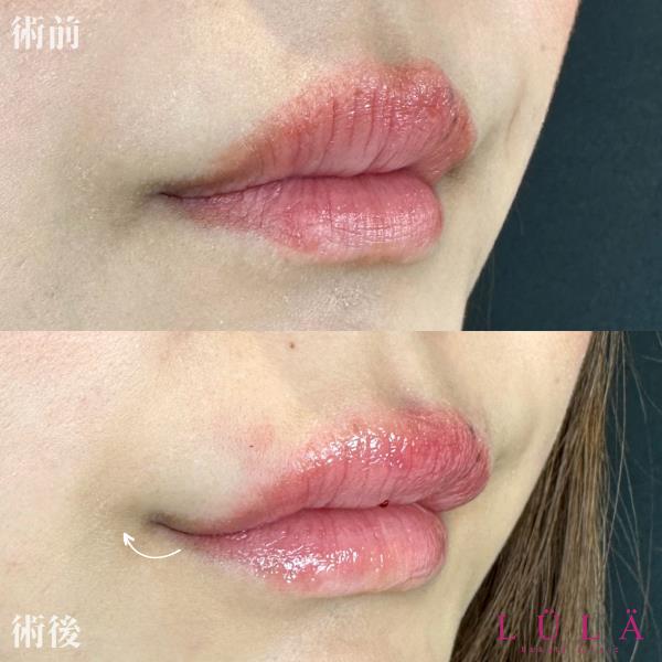 Cカールリップの症例写真