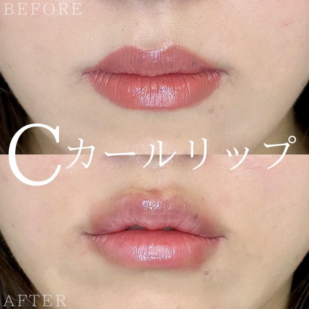 Cカールリップの症例写真