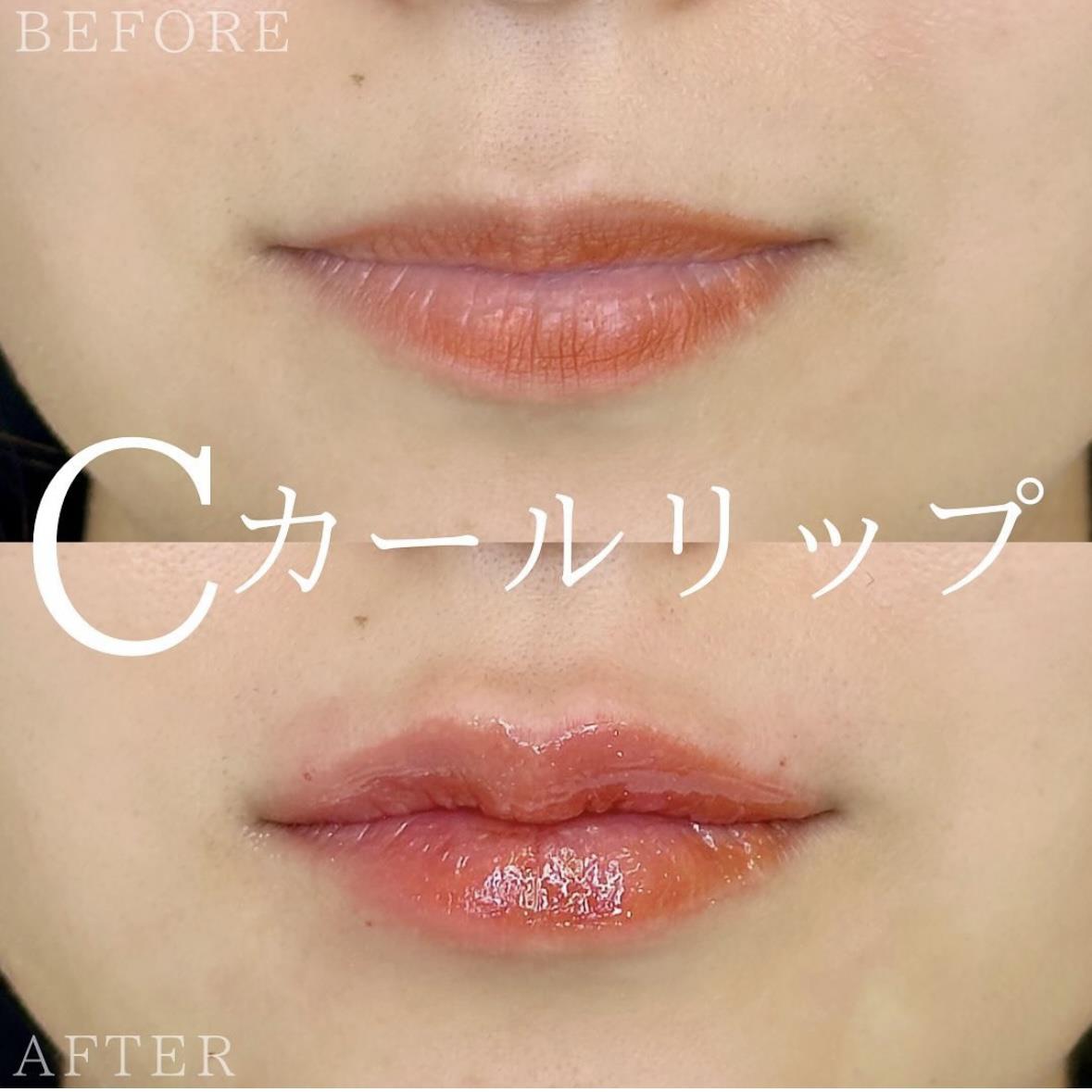 Cカールリップの症例写真