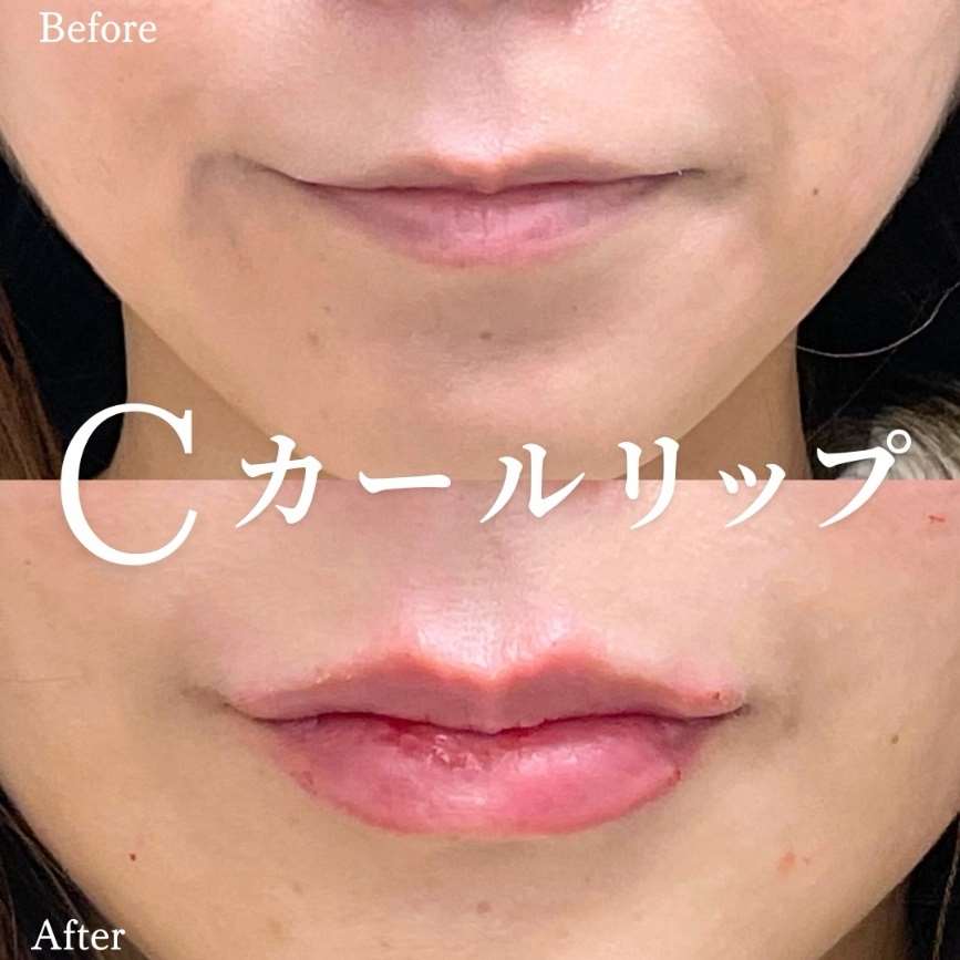 Cカールリップの症例写真