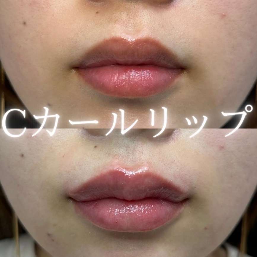 Cカールリップの症例写真