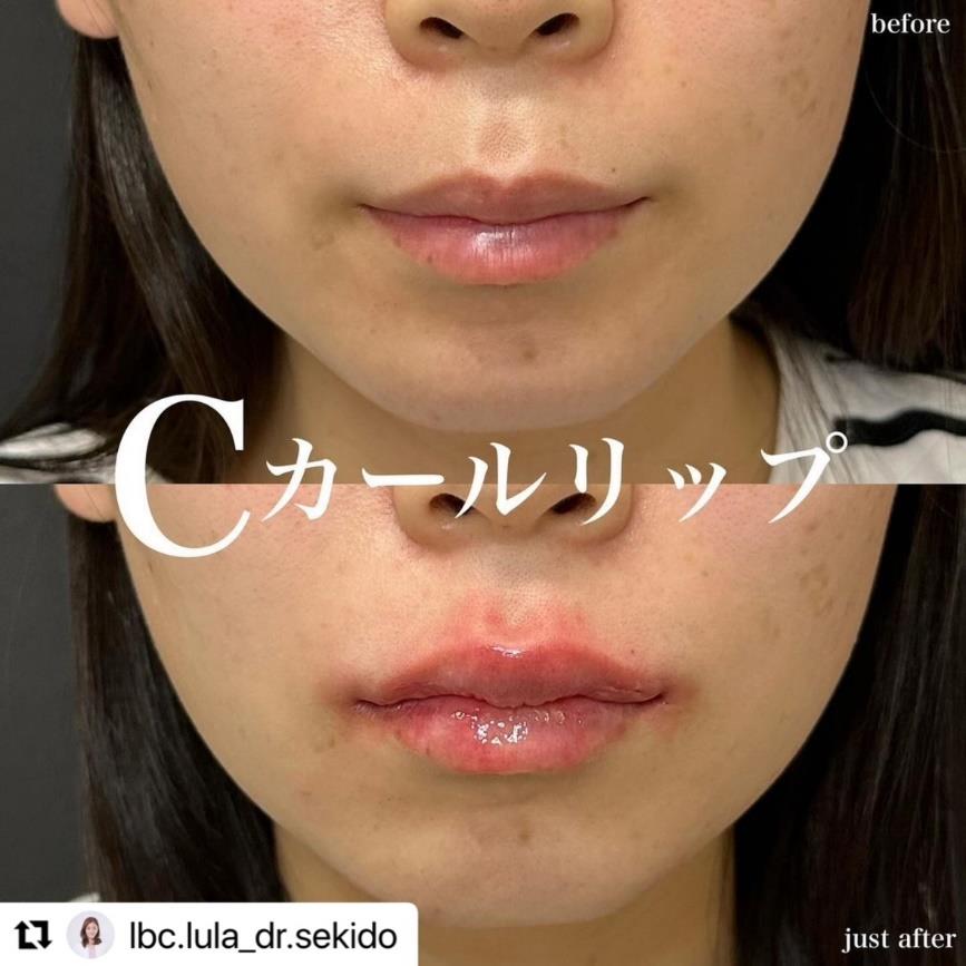 Cカールリップの症例写真