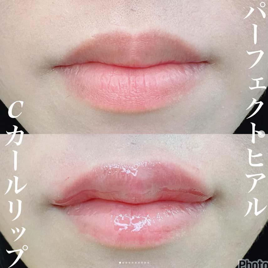 Cカールリップの症例写真
