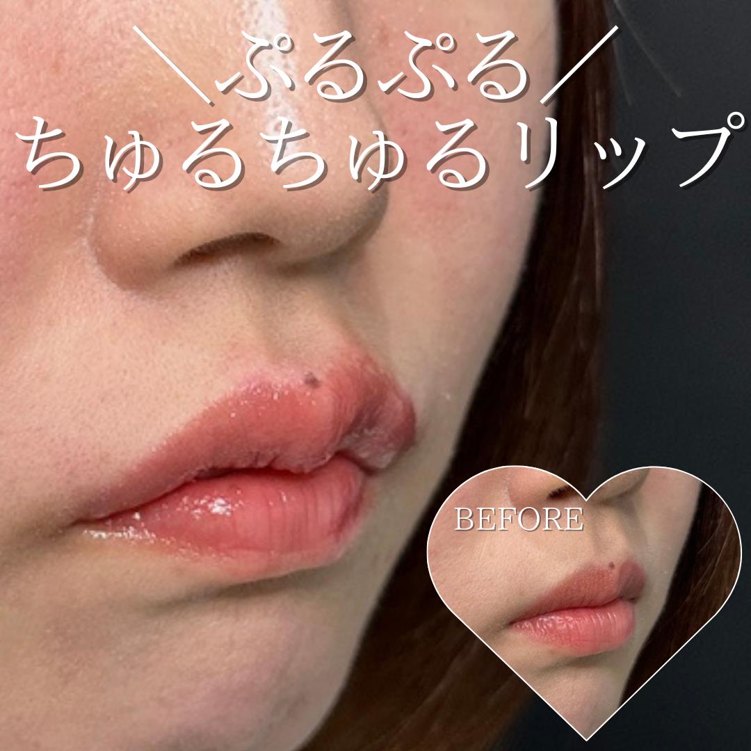 Cカールリップの症例写真