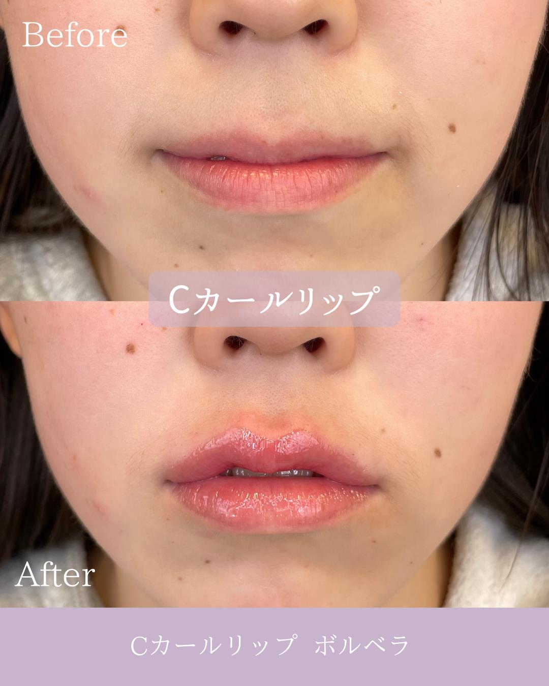 Cカールリップの症例写真