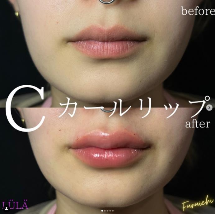 Cカールリップの症例写真