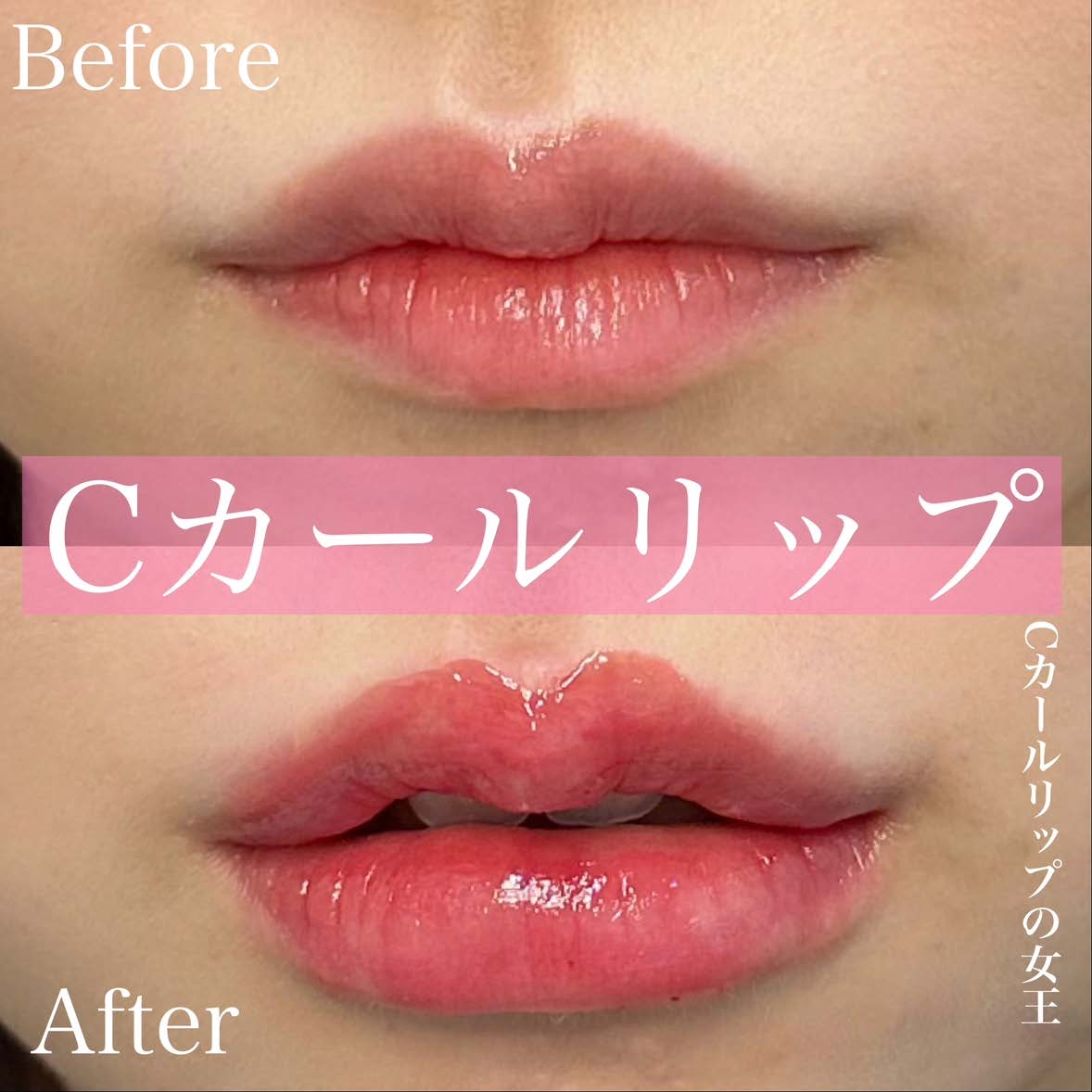 Cカールリップの症例写真