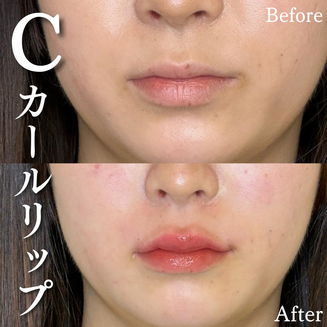 Cカールリップの症例写真