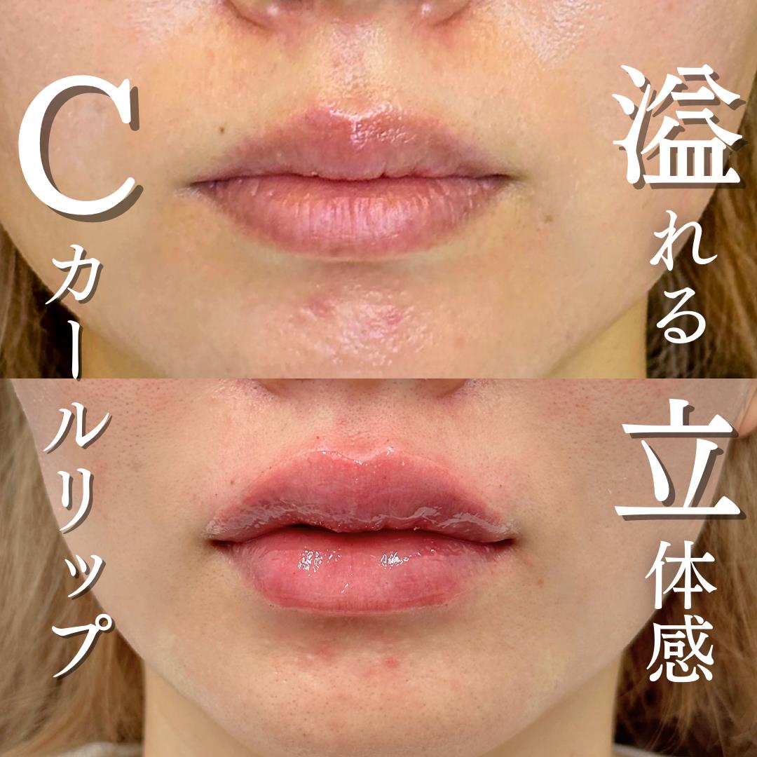 Cカールリップの症例写真