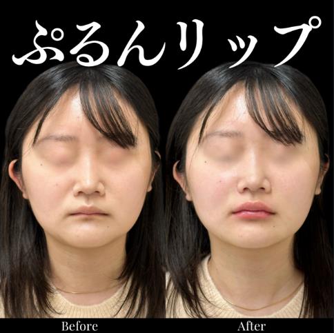 Cカールリップの症例写真