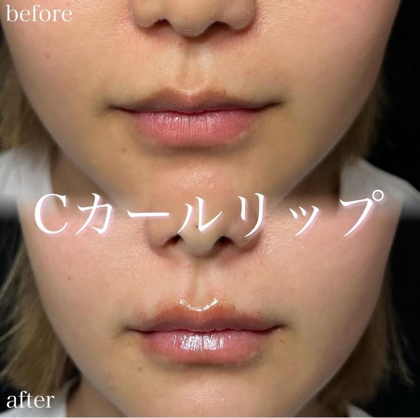 Cカールリップの症例写真