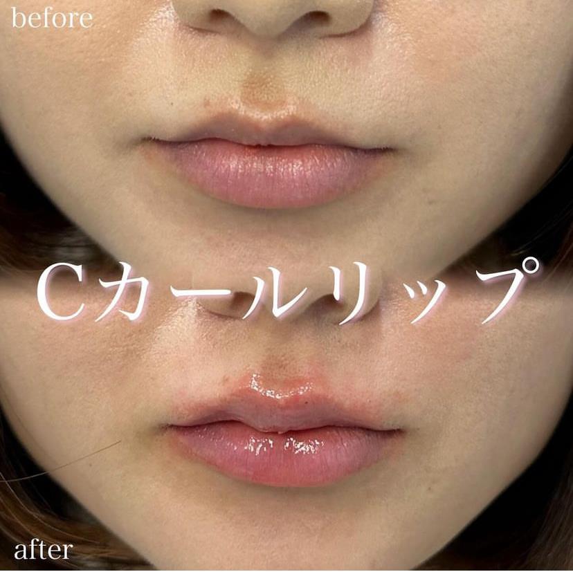 Cカールリップの症例写真