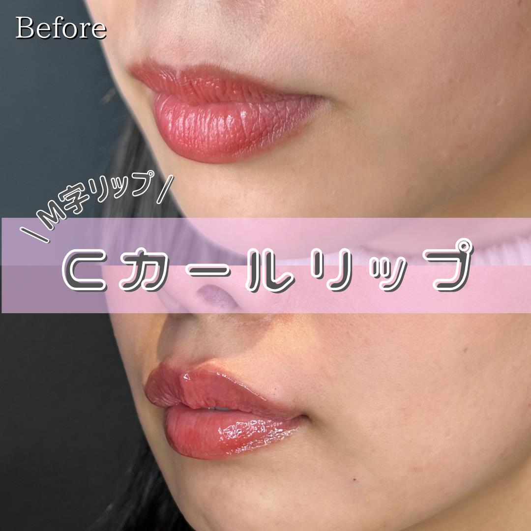 Cカールリップの症例写真