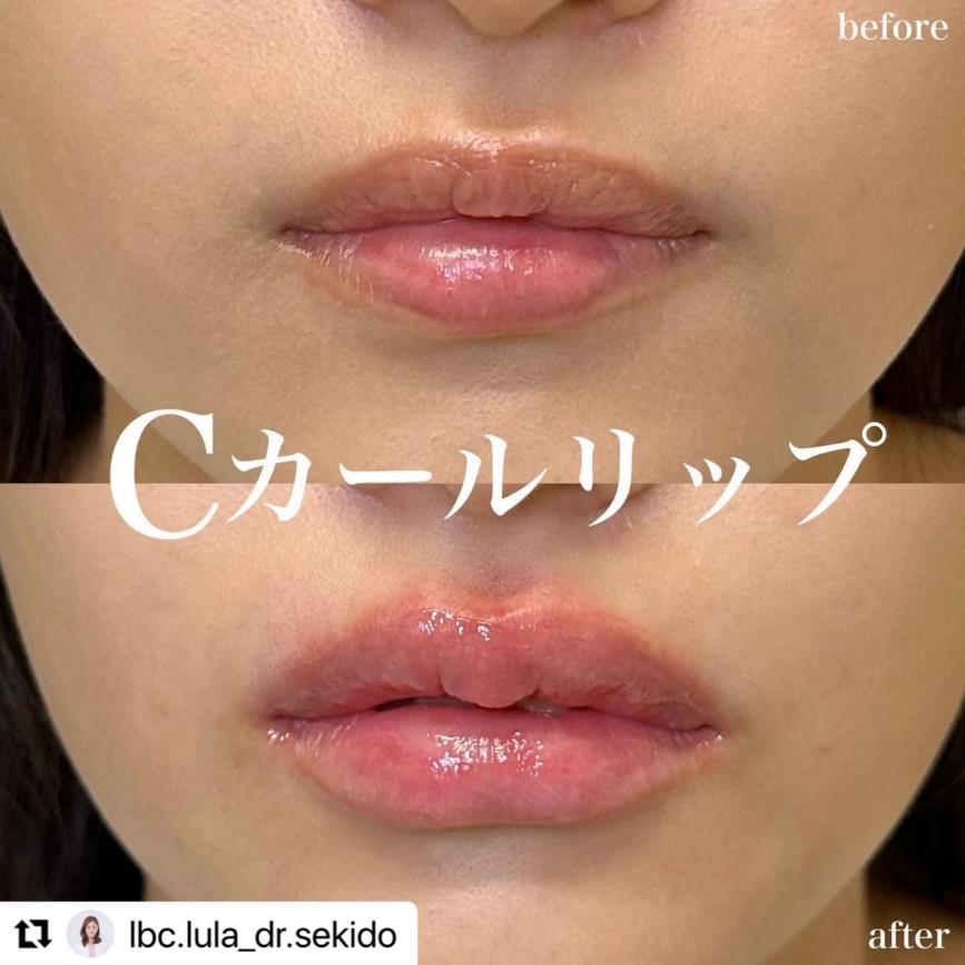 Cカールリップの症例写真