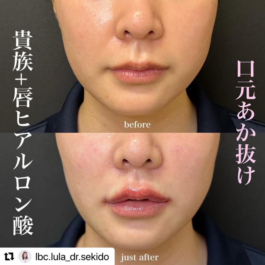 Cカールリップの症例写真