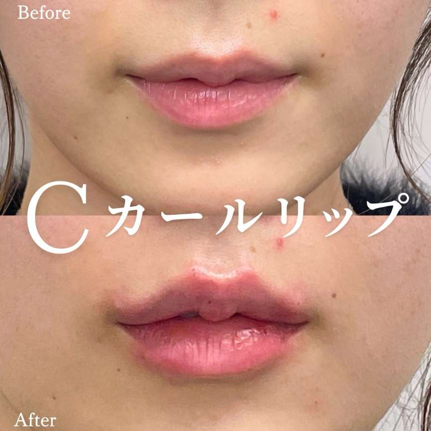 Cカールリップの症例写真