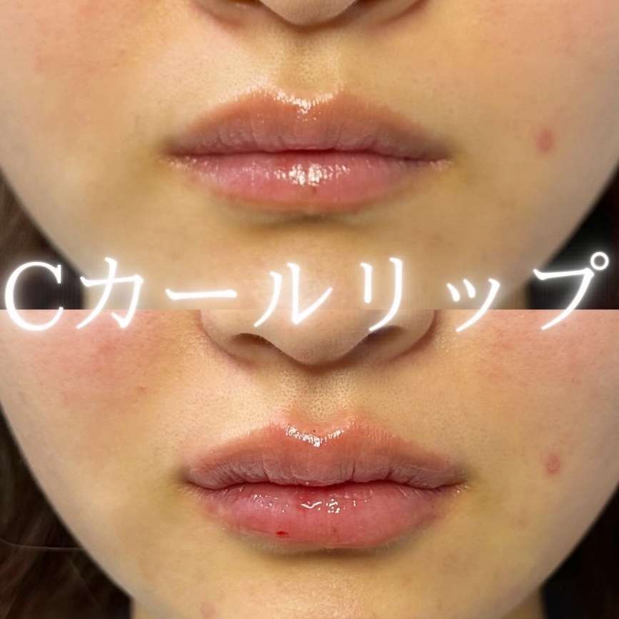 Cカールリップの症例写真