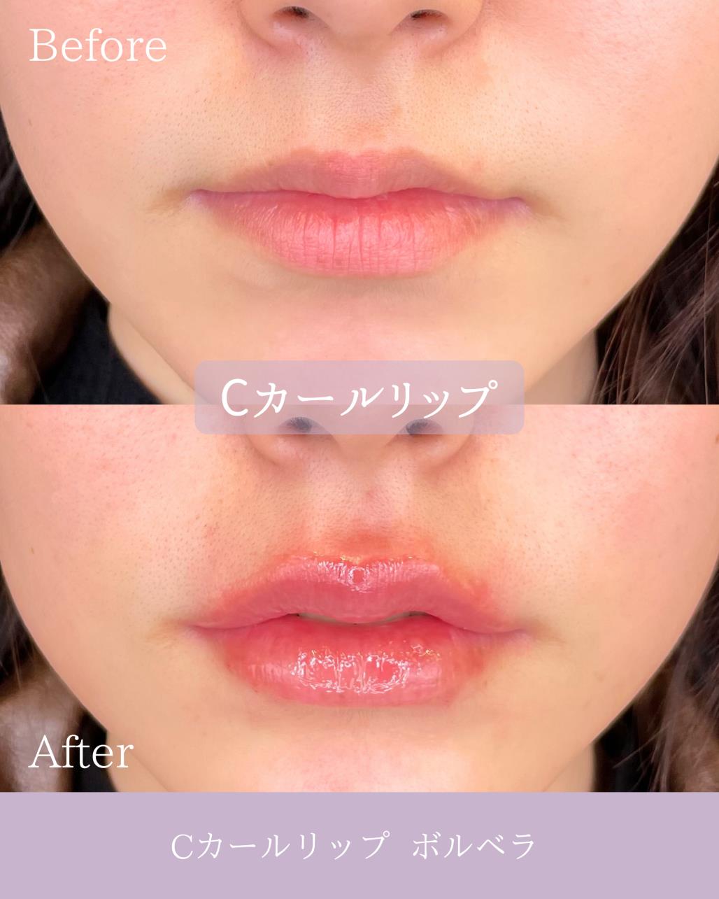 Cカールリップの症例写真