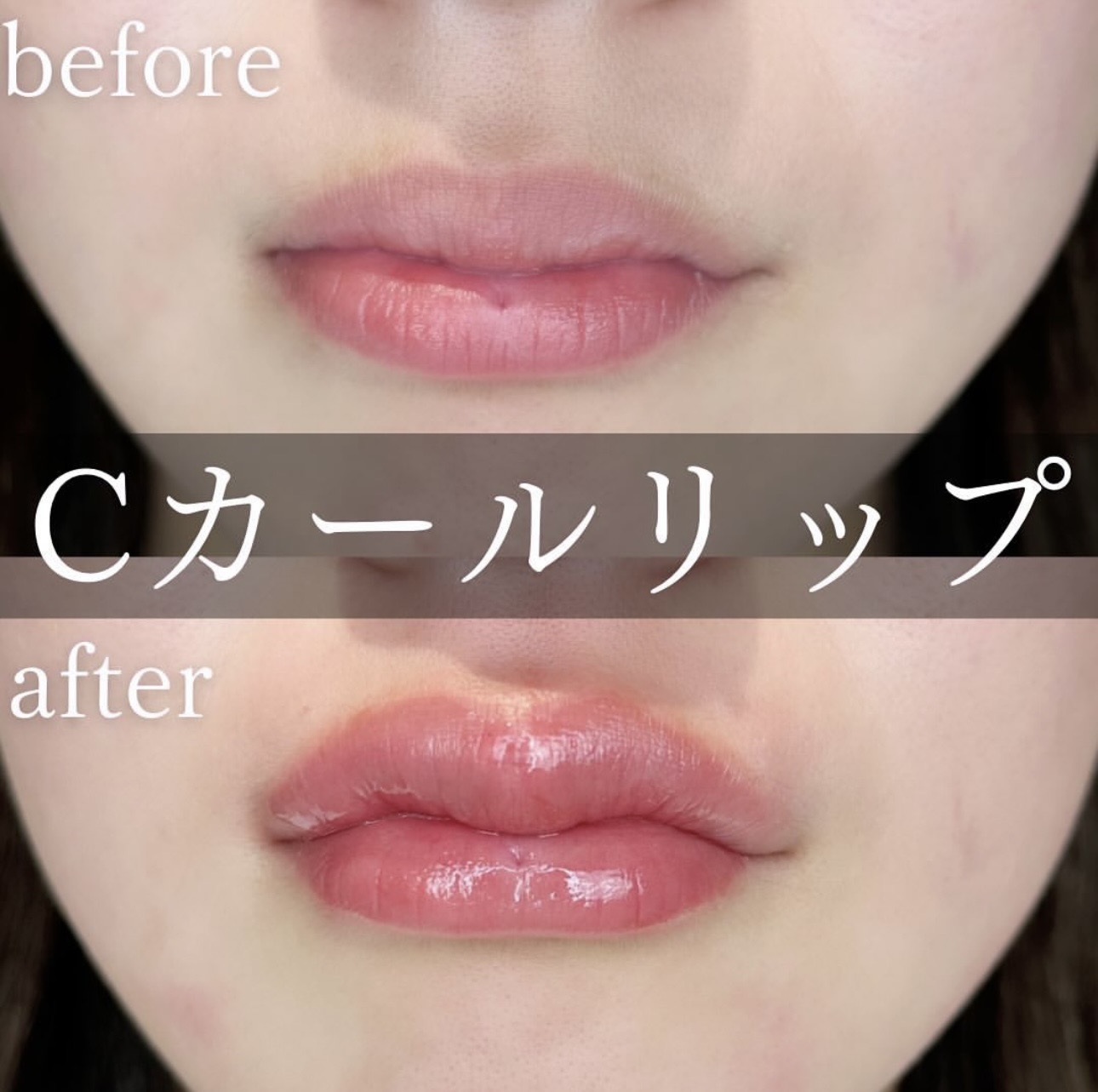 Cカールリップの症例写真