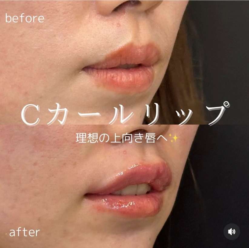 Cカールリップの症例写真