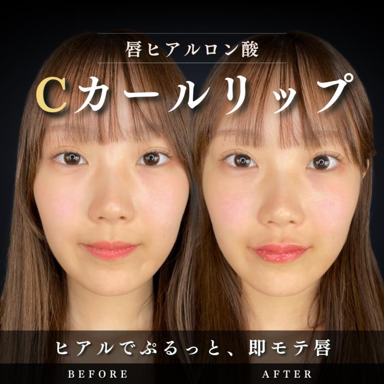 Cカールリップの症例写真