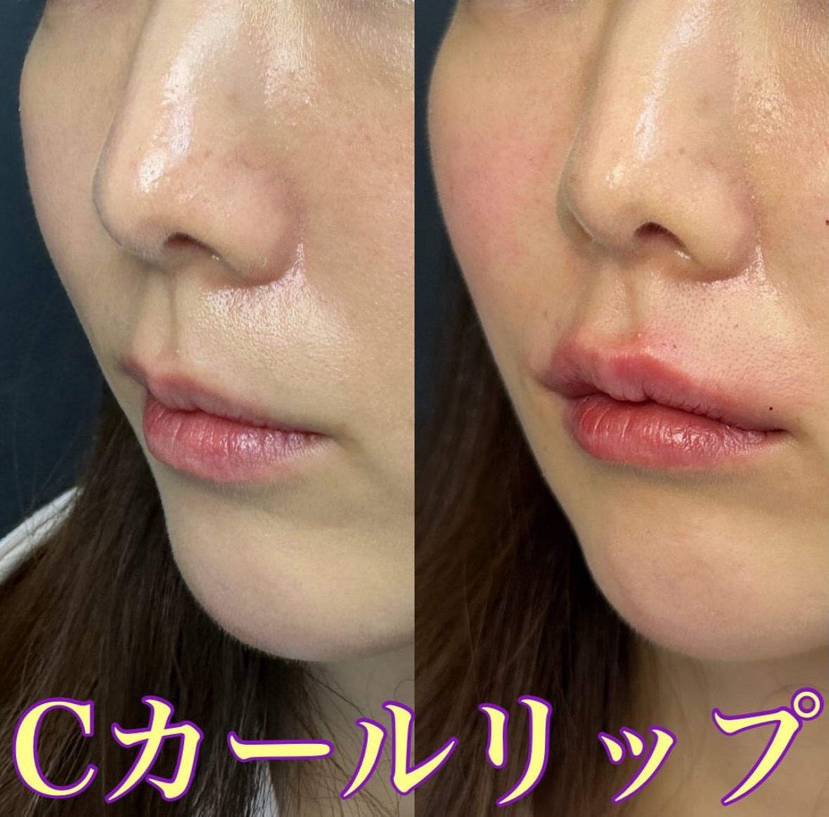 Cカールリップの症例写真