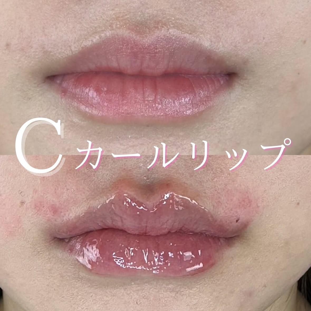 Cカールリップの症例写真