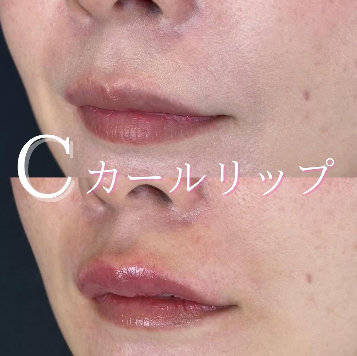 Cカールリップの症例写真