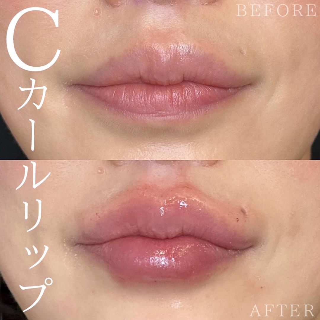 Cカールリップの症例写真
