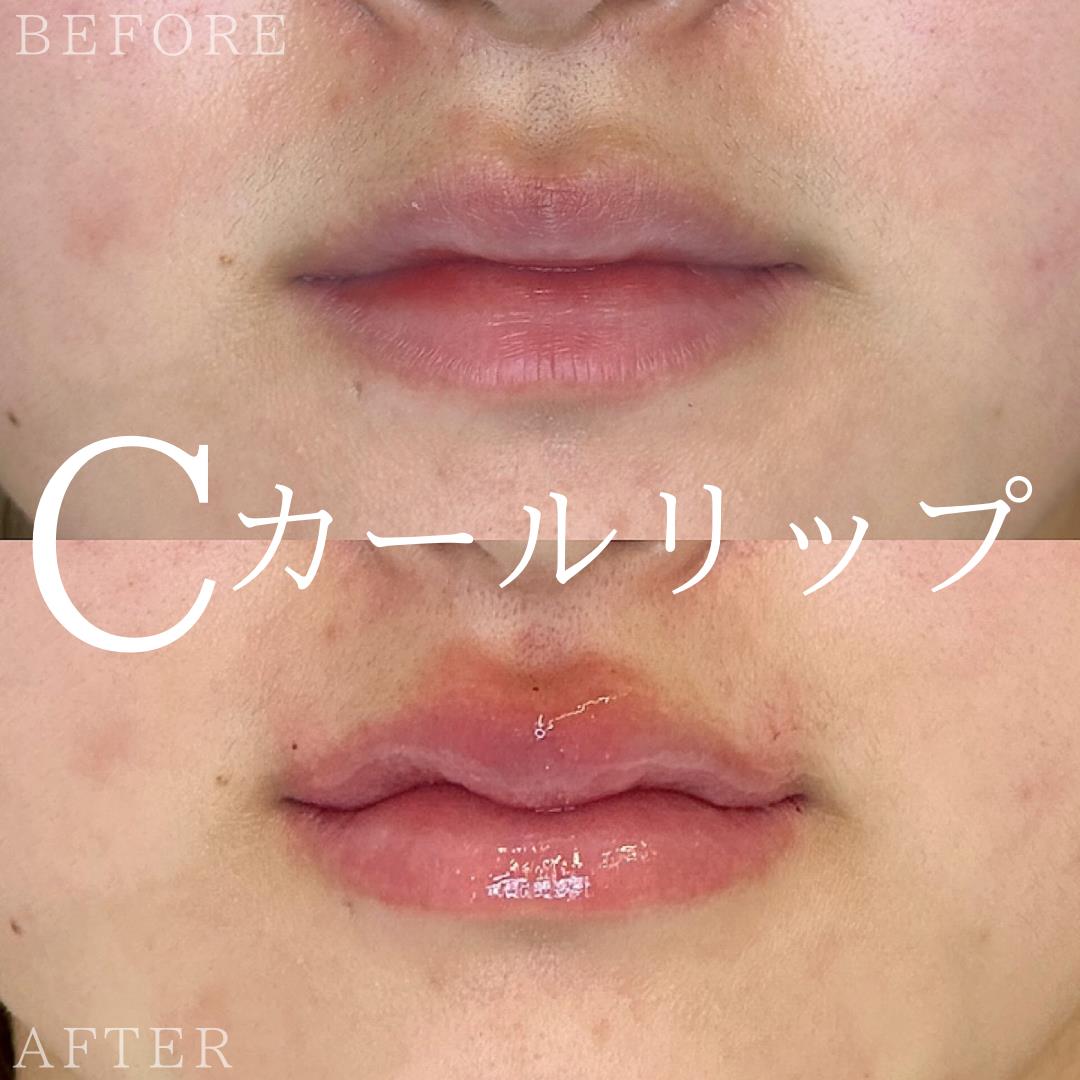 Cカールリップの症例写真