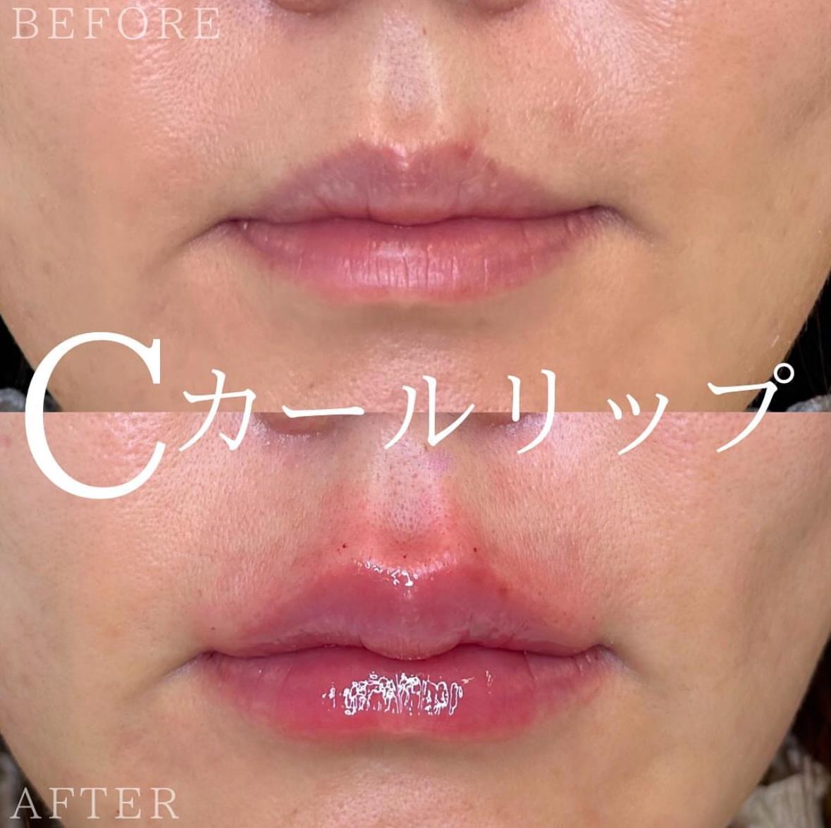 Cカールリップの症例写真