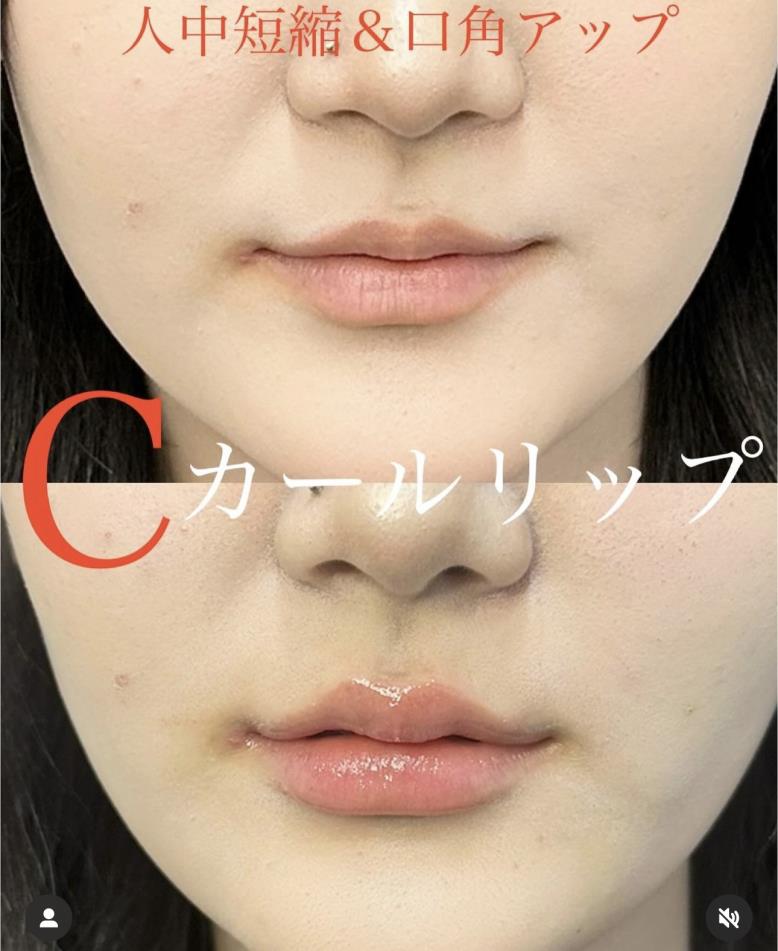 Cカールリップの症例写真