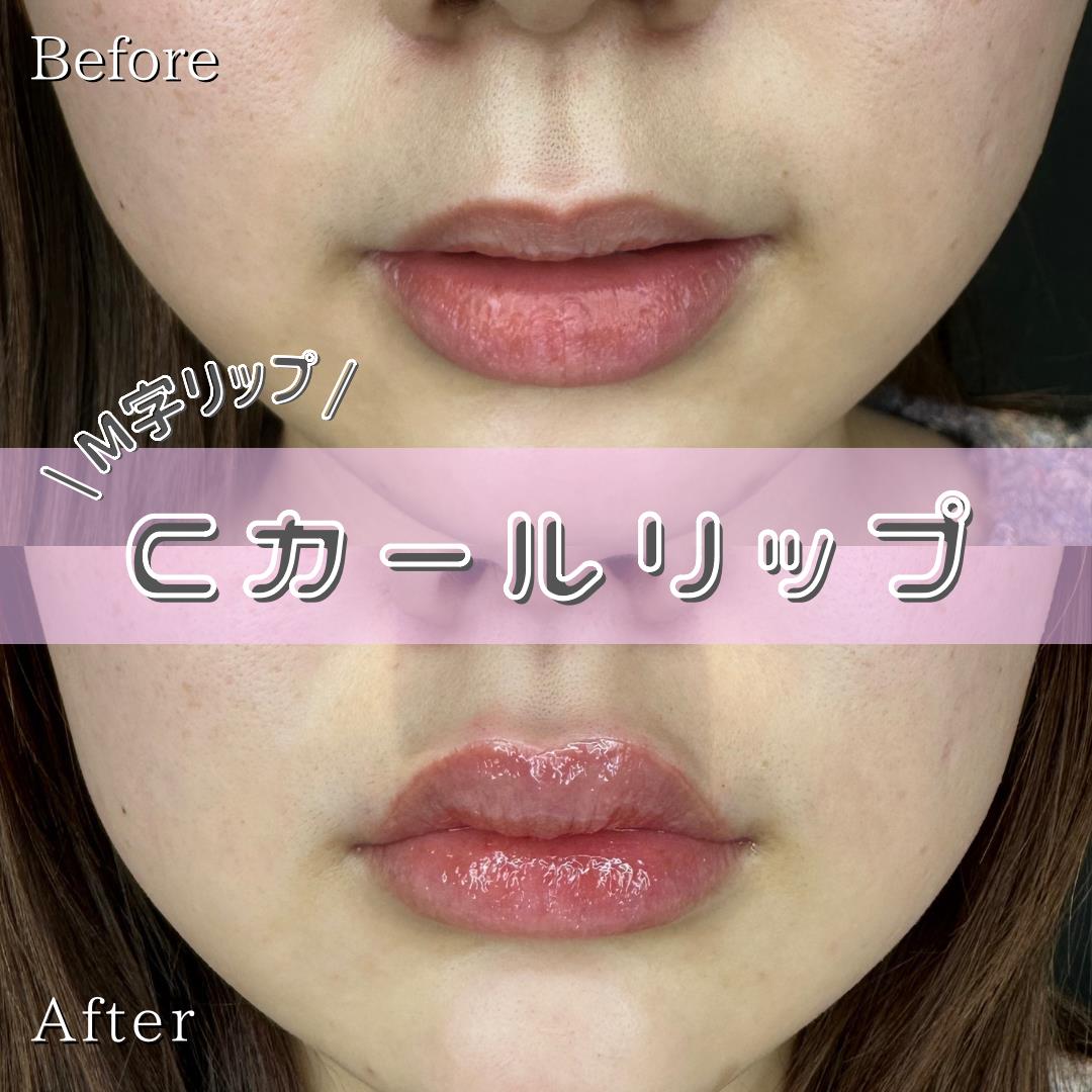 Cカールリップの症例写真