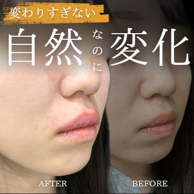 Cカールリップの症例写真