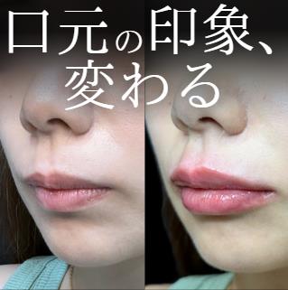 Cカールリップの症例写真