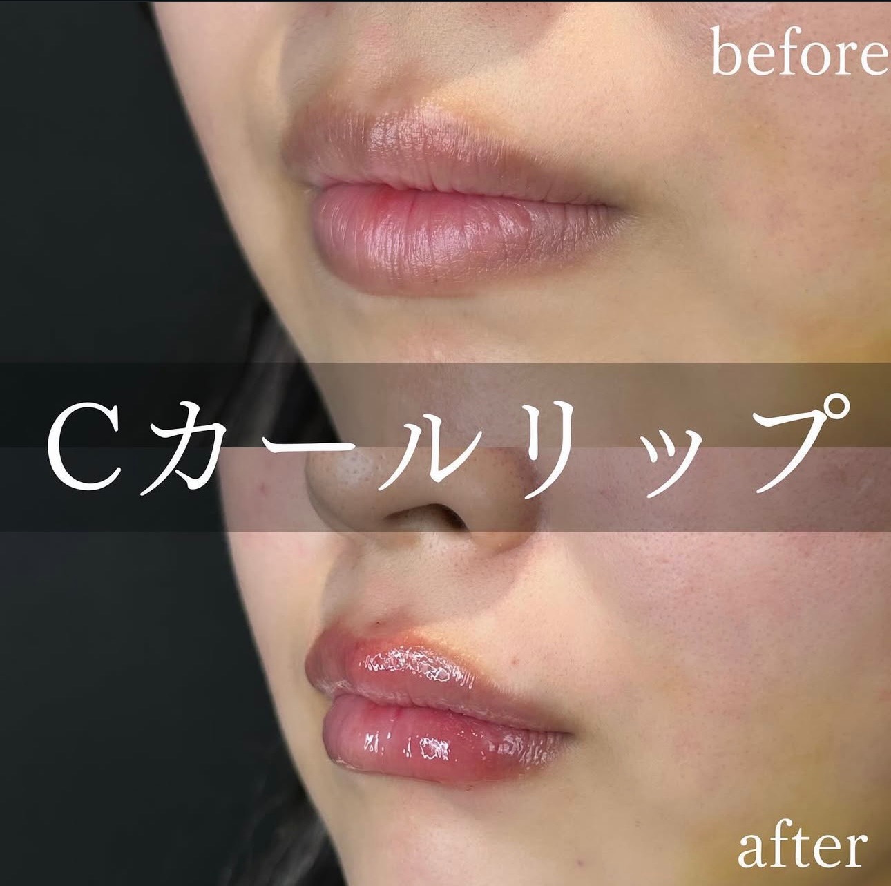 Cカールリップの症例写真