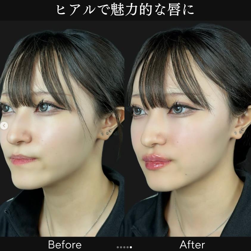 Cカールリップの症例写真