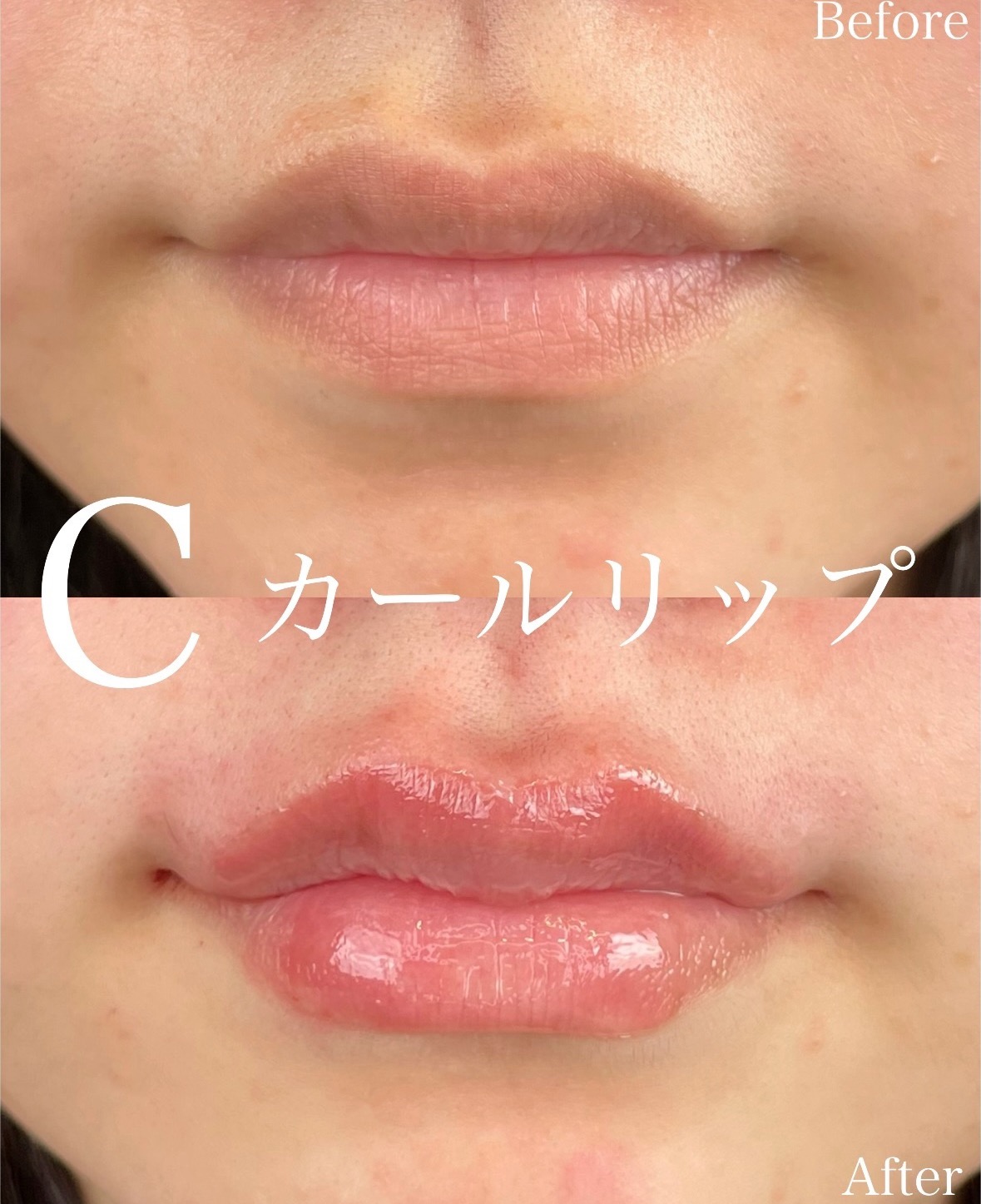 Cカールリップの症例写真