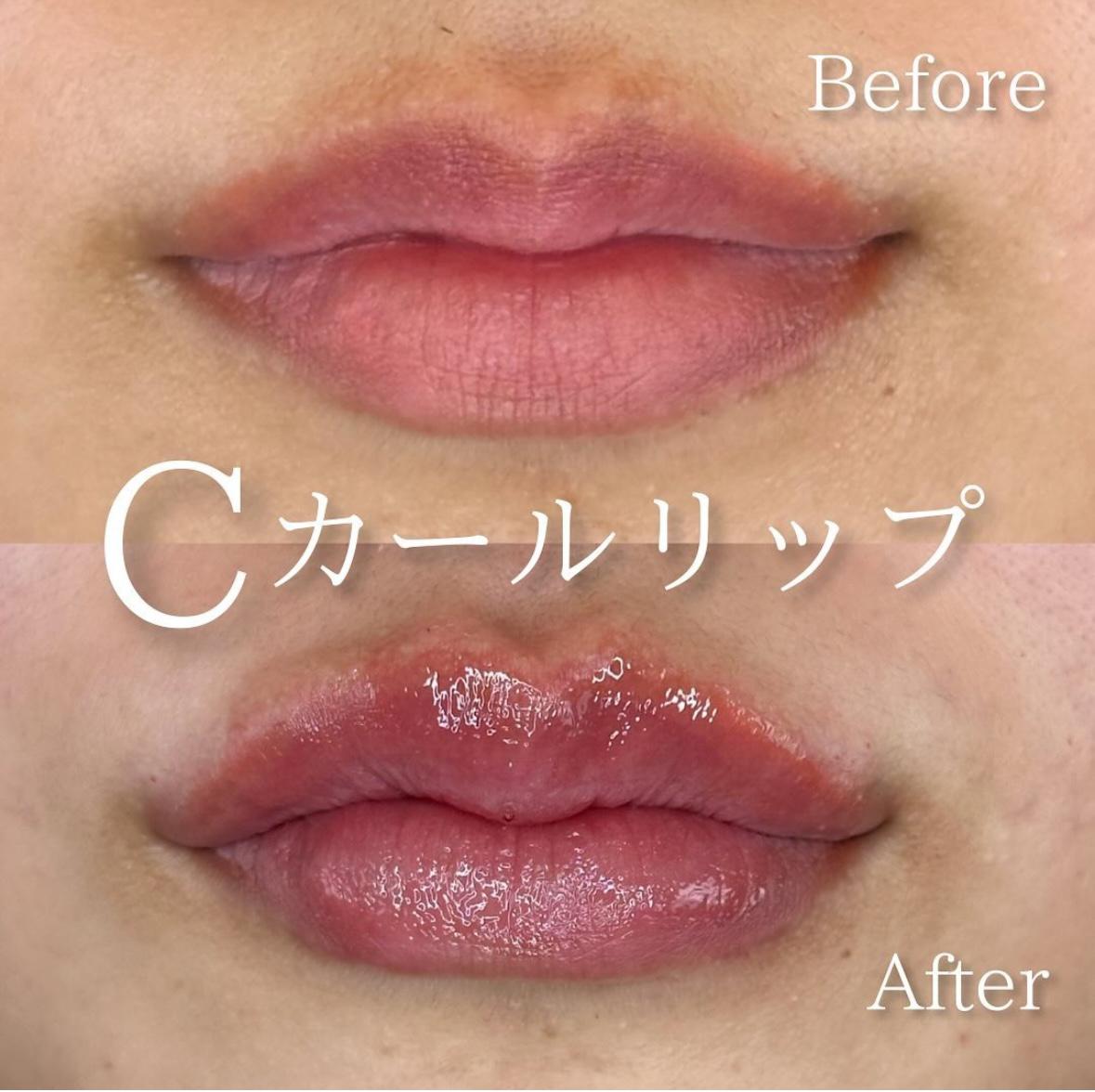 Cカールリップの症例写真