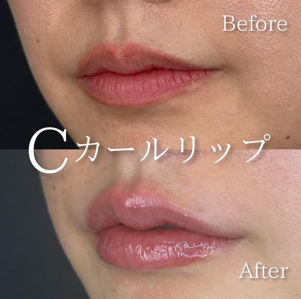 Cカールリップの症例写真